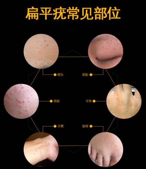 昆明治疗扁平疣